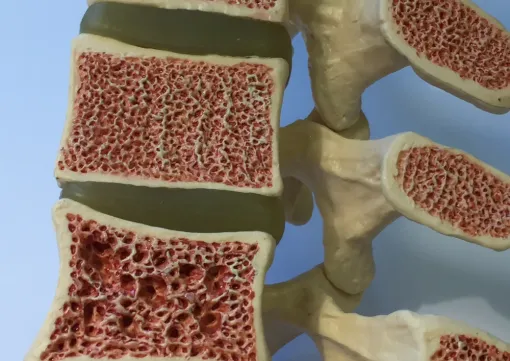 Comment soulager l'ostéoporose à Toulouse ?, Toulouse, Marion