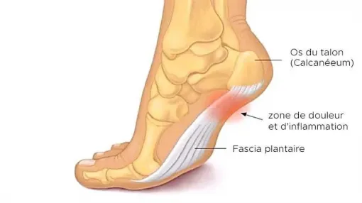 Comment soulager une aponévrosite plantaire à Toulouse, Toulouse, Marion