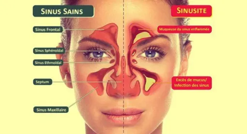 Quelle méthode pour une sinusite chronique à Toulouse ?, Toulouse, Marion