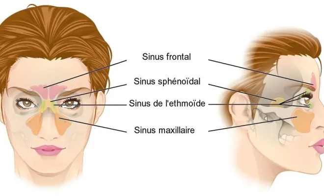Quelle méthode pour une sinusite chronique à Toulouse ?, Toulouse, Marion