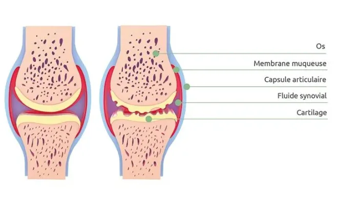 Arthrose : symptômes et solutions pour soulager la douleur à Toulouse, Toulouse, Marion