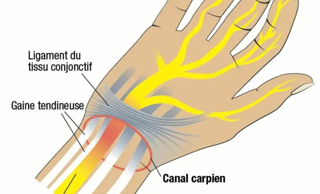 Canal carpien à Toulouse : comment soulager les fourmillements et douleurs de la main ?, Toulouse, Marion