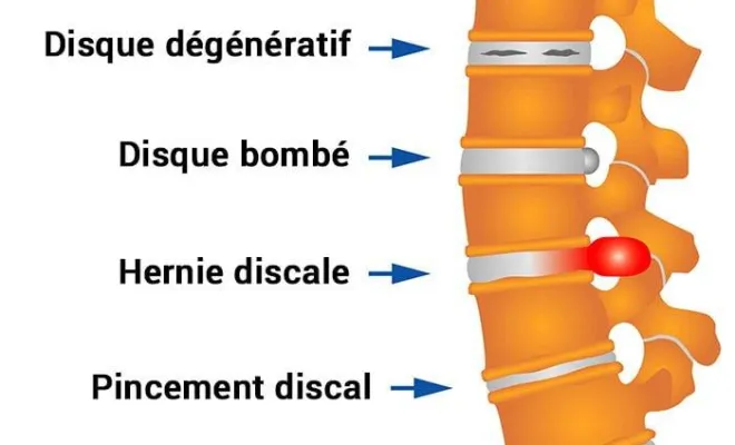 Dorsalgie Hernie discale Discopathie