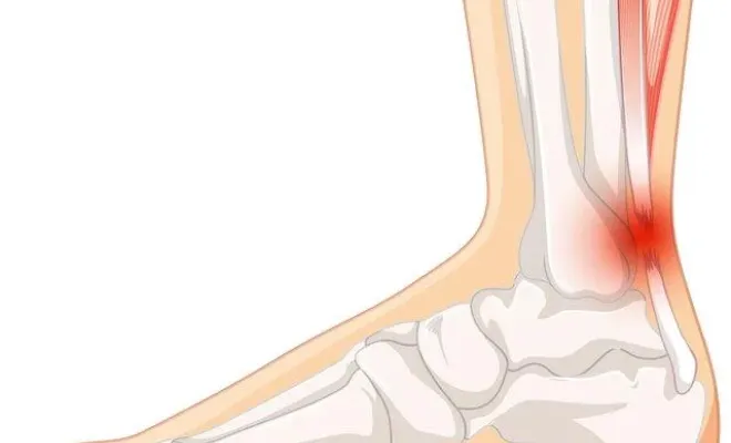 Comment soulager un tendon d'Achille douloureux à Toulouse, Toulouse, Marion