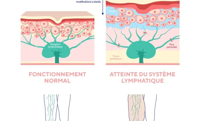 Choisir un drainage lymphatique professionnel à Toulouse, Toulouse, Marion